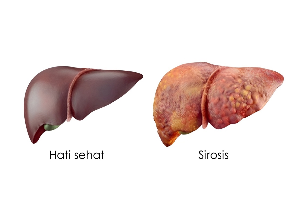 Sirosis Hati - Indonesiare.co.id