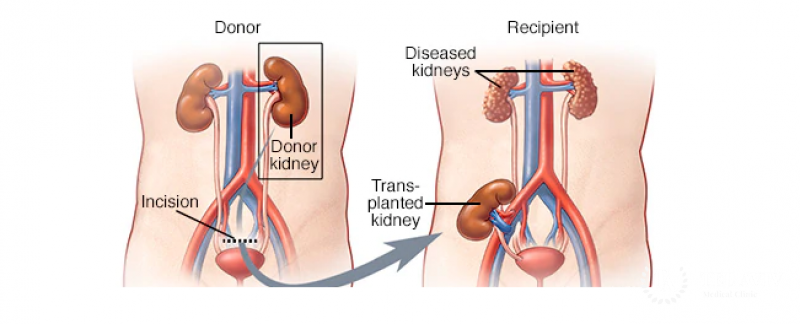 Transplantasi Ginjal - tamc.co.il
