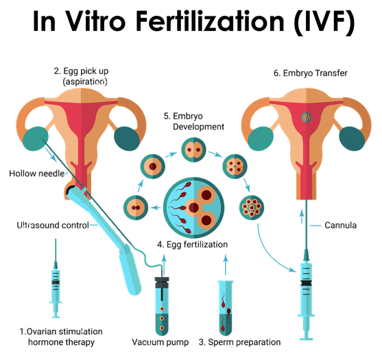Treatment IVF - delhi-ivf.com